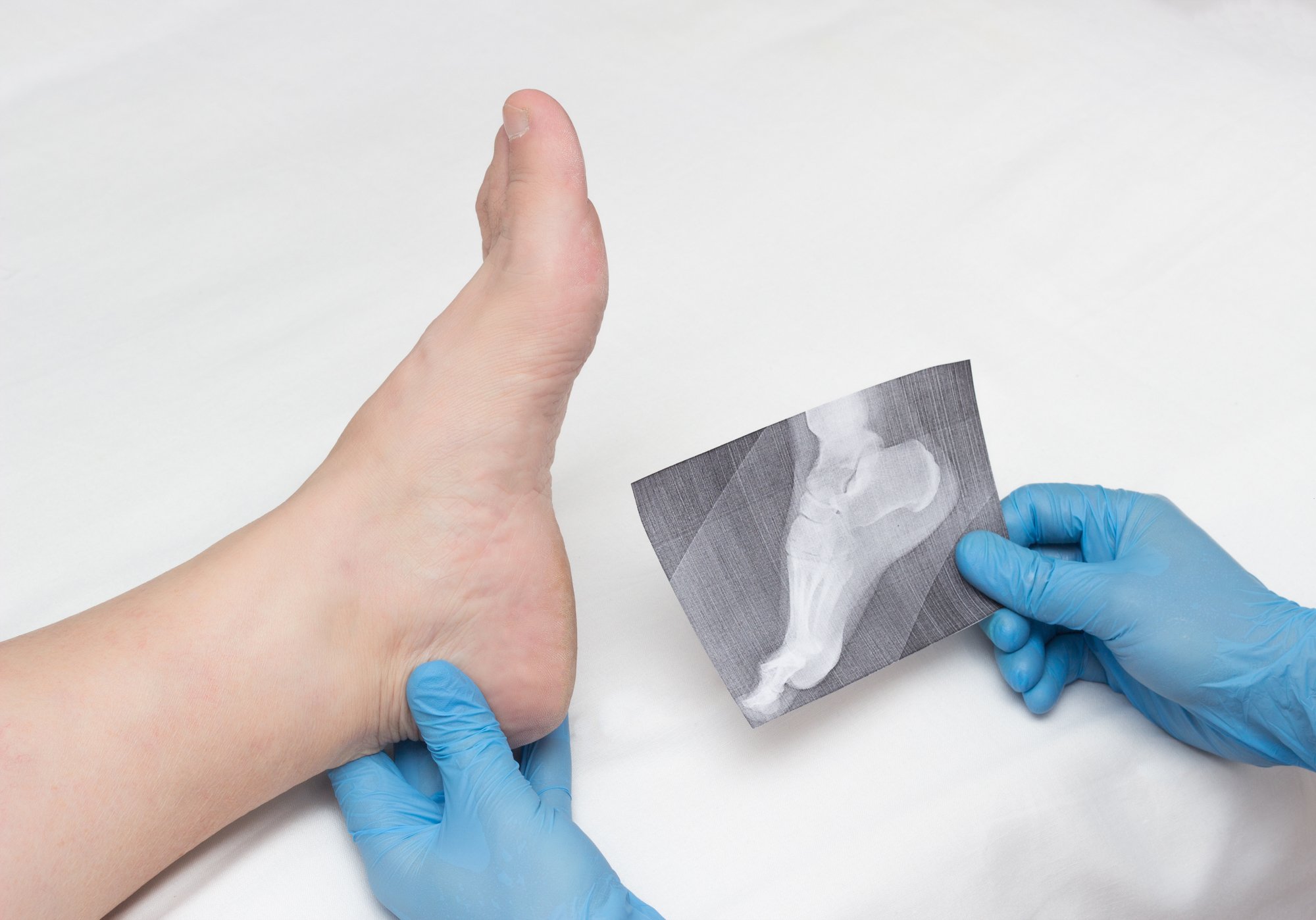 Physician Evaluating Heel Spur on Young Patient
