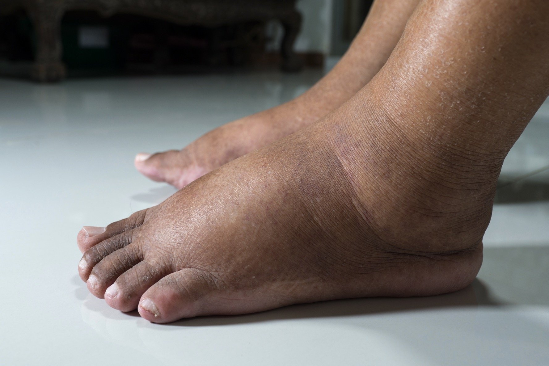 Person with swollen feet suffering from diabetes mellitus