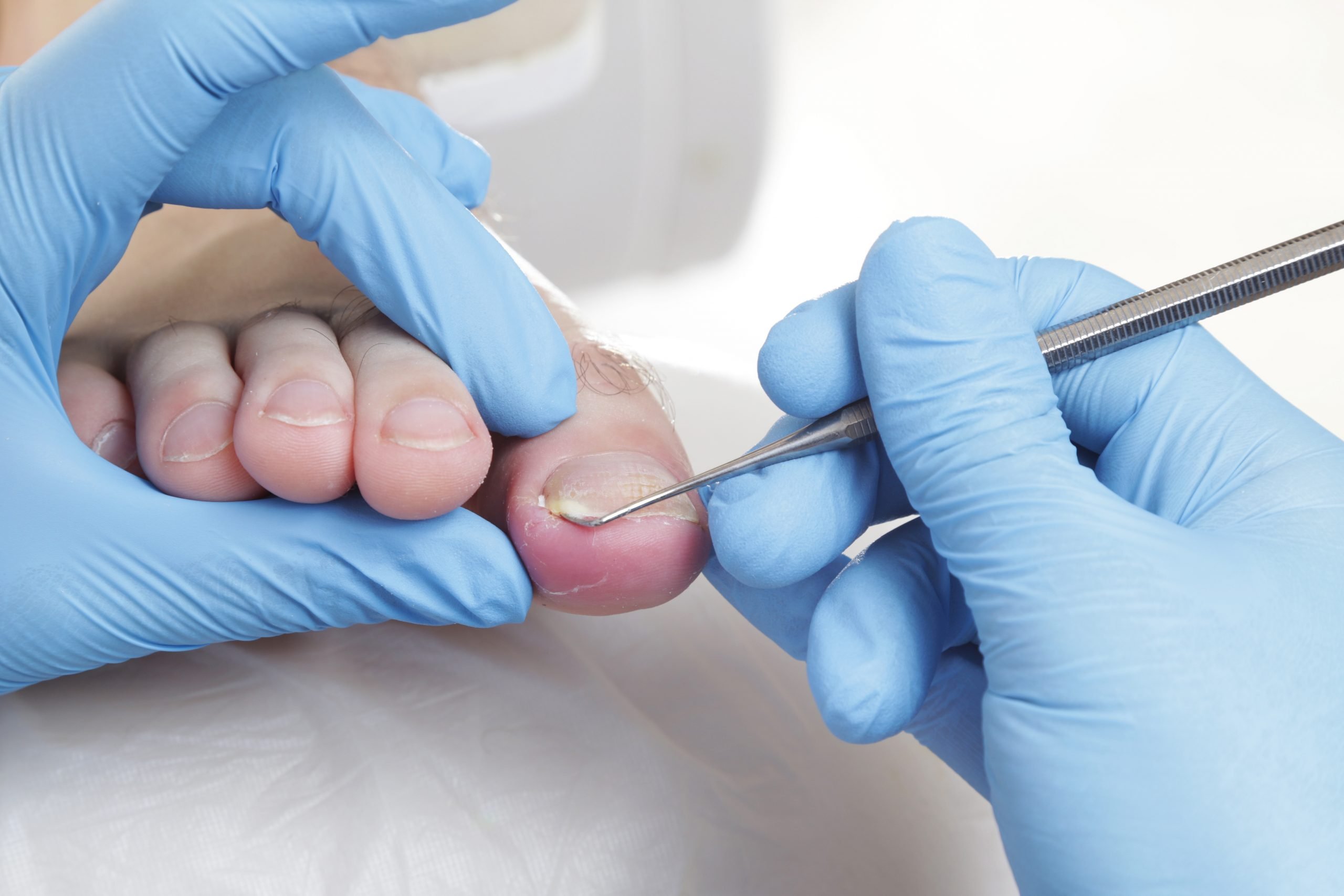 ingrown-toenails_afd-common-foot-problem Doctor treating an ingrown toenail on male patient
