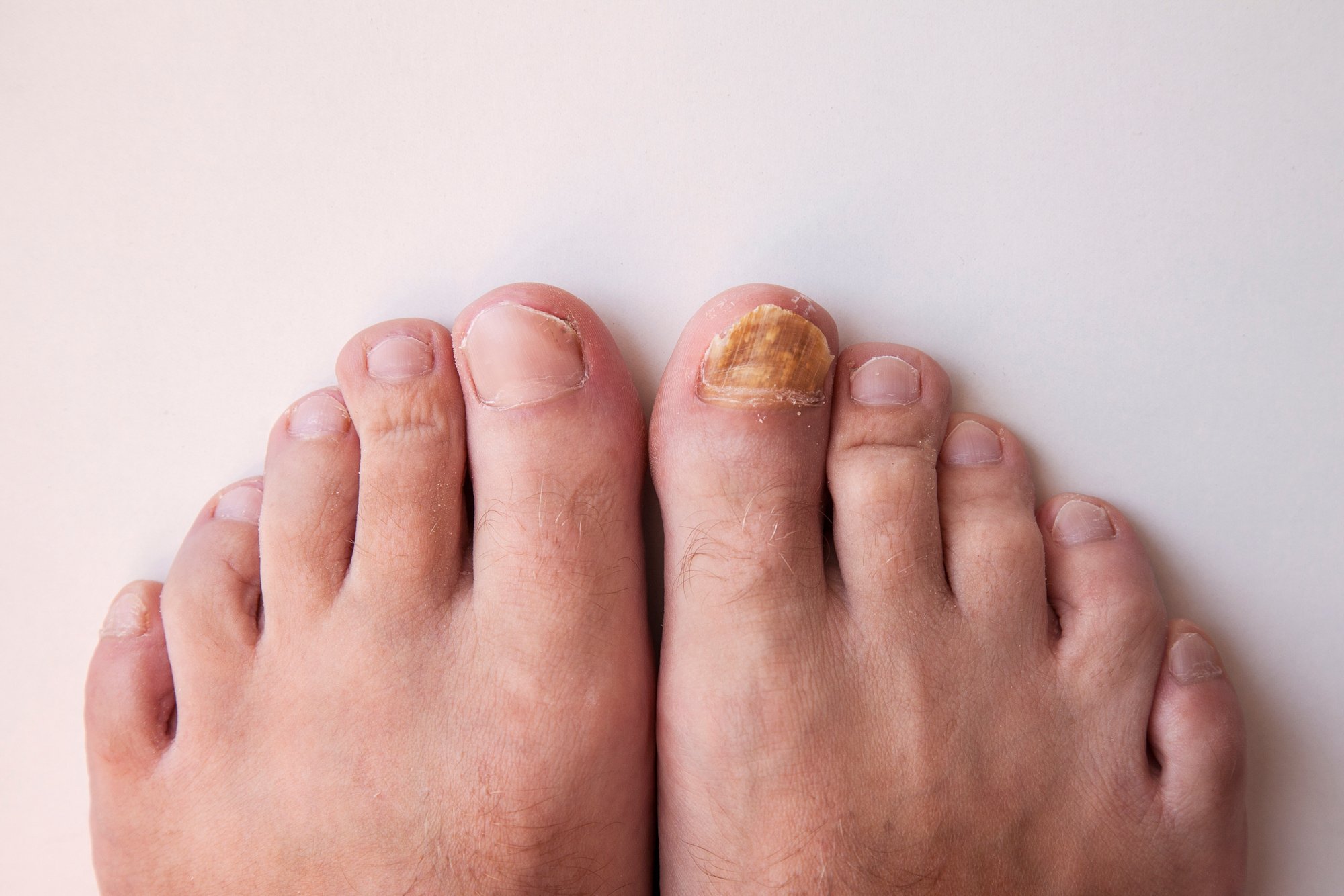 toenail-fungus_afd-common-foot-problem Feet with toenail fungus on the big right toe