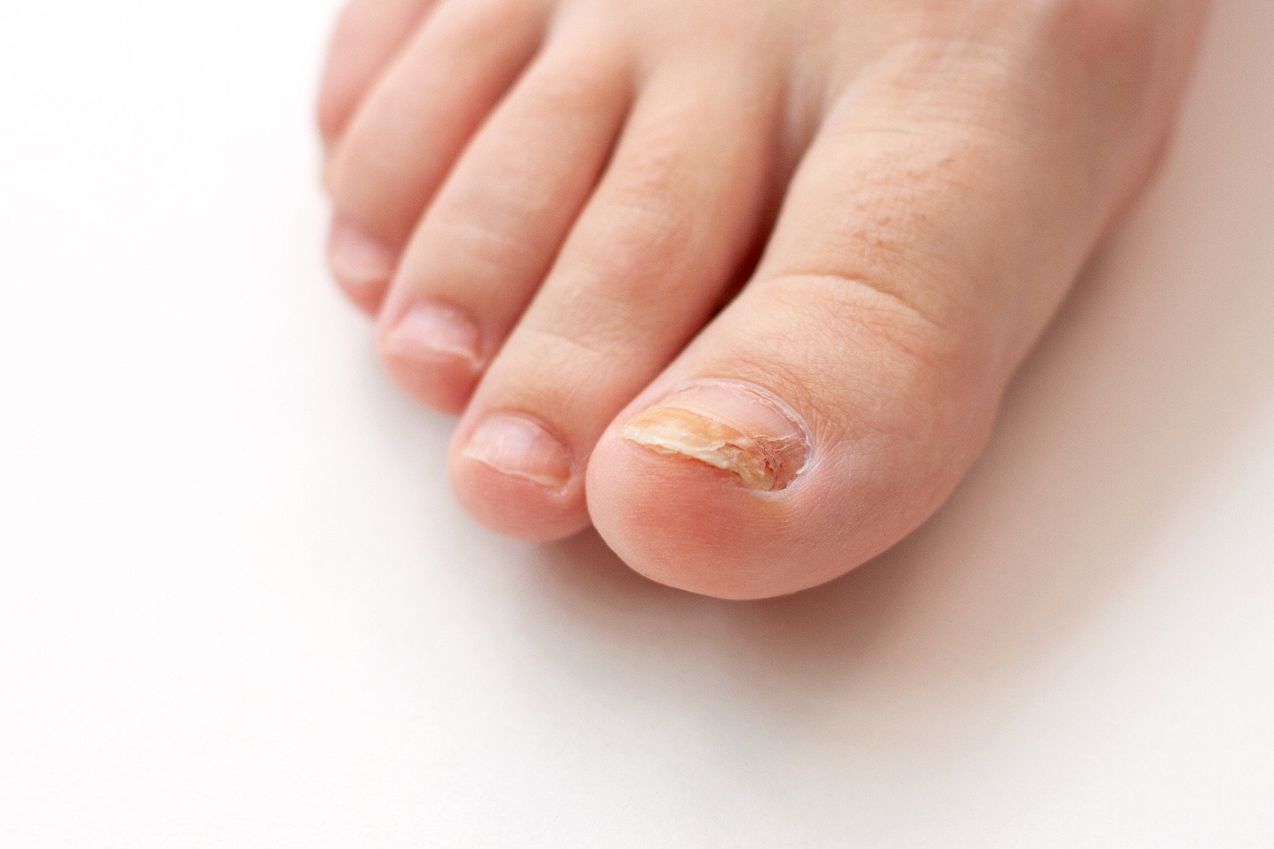 A toe nail that has been infected by a fungus